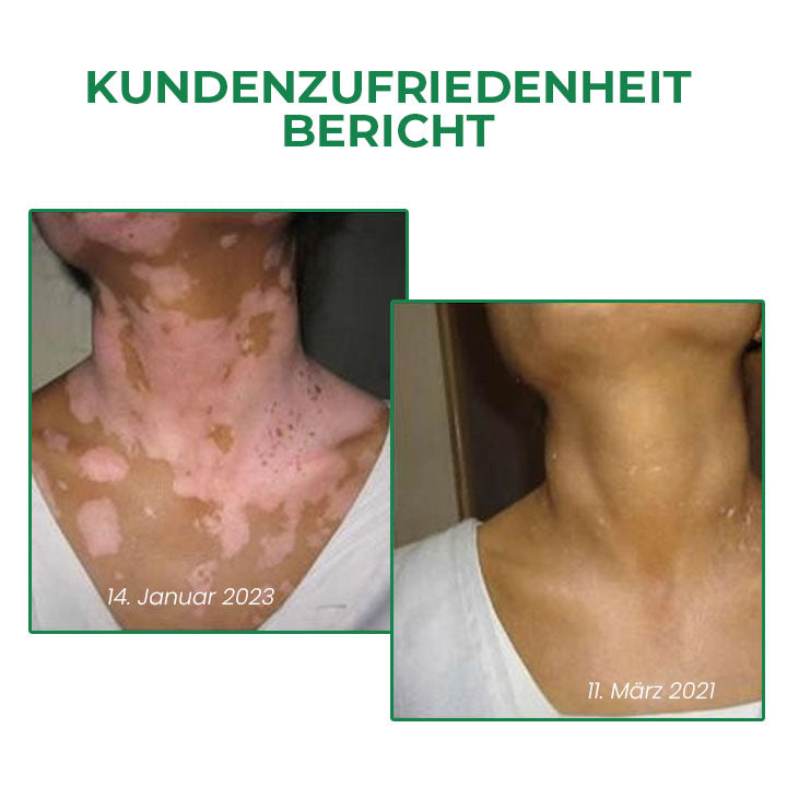 Oveallgo™ PRO VitiligoFix Revitalisierendes Elixier