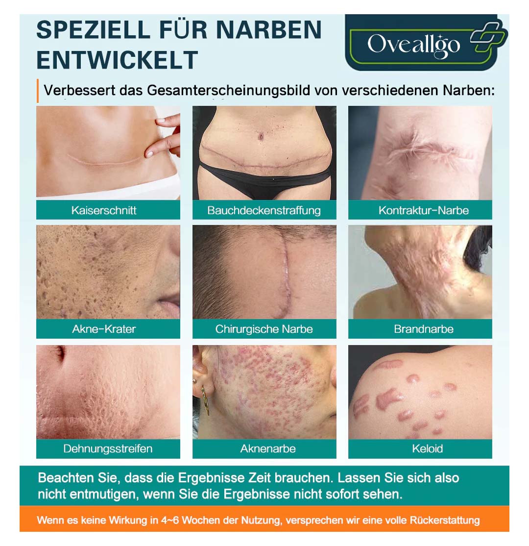 Oveallgo™ LUX Fortgeschrittenes Spray zur Narbenentfernung