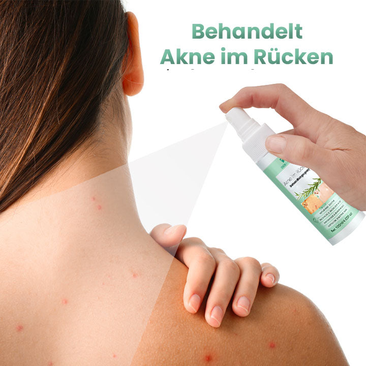 DerMist Rücken Akne Behandlung Kräuterspray