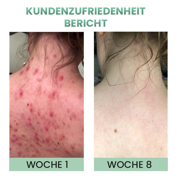 German DerMistPRO Rücken Akne Behandlung Kräuterspray