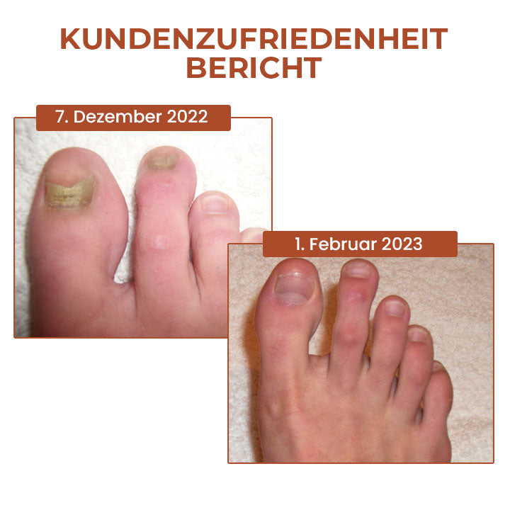 Oveallgo™ 7 Tage LUX Maximale Stärke Nagel-Reparatur-Serum