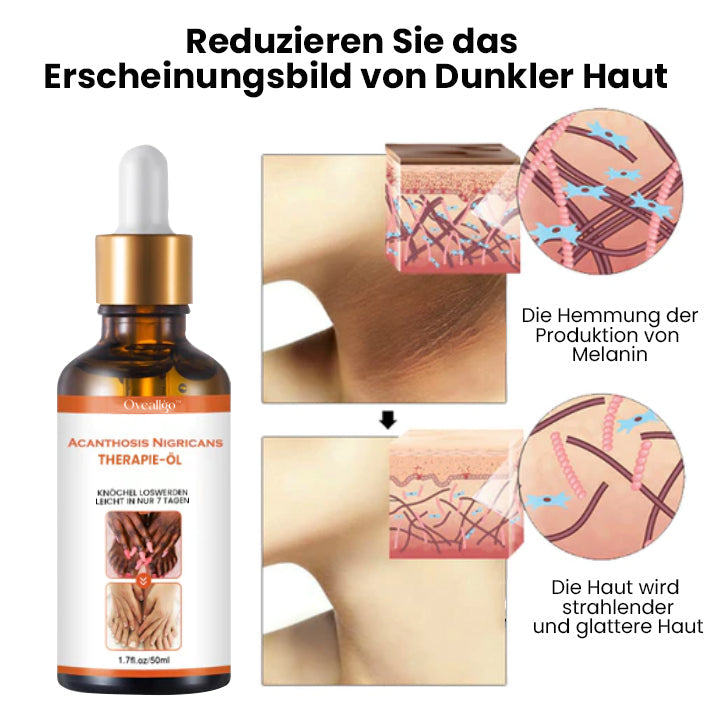 Oveallgo™ Akanthose LUX Nigricans Therapieöl