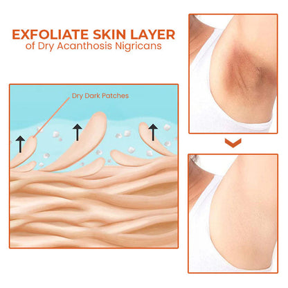 Oveallgo™ Akanthose Nigricans Therapieöl