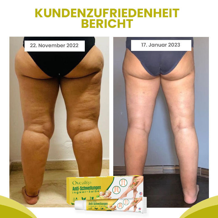 Oveallgo™ Profi AnschwellenAuswärts Bein Comfort Ingwer-Salbe