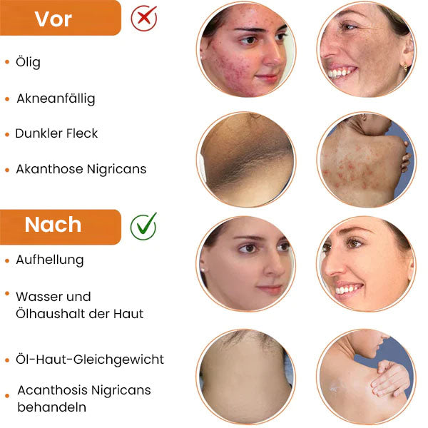 AcneVanish Profi Reinigungslotion für Akne & Pickel & Acanthosis Nigricans