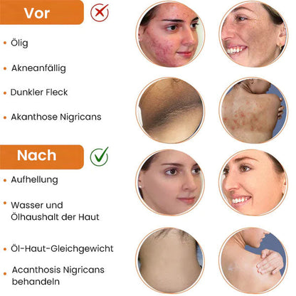 AcneVanish Profi Reinigungslotion für Akne & Pickel & Acanthosis Nigricans