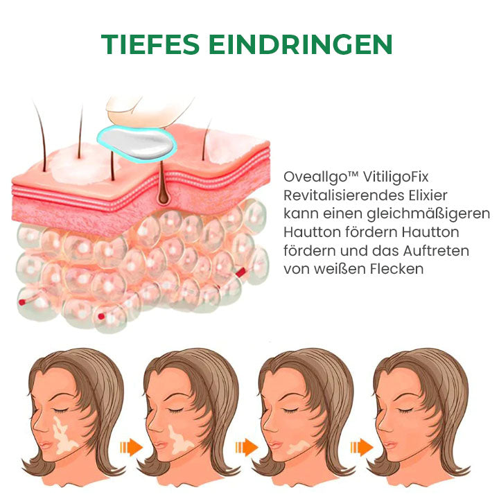 Oveallgo™ VitiligoFix X Revitalisierendes Elixier