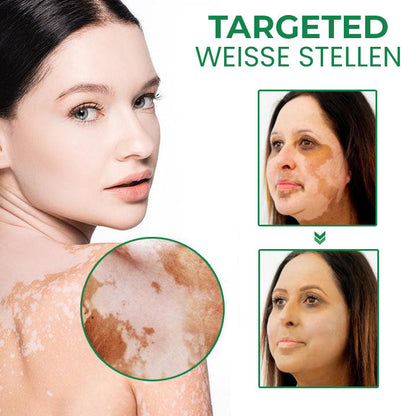 Oveallgo™ VitiligoFix Revitalisierendes Elixier