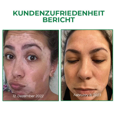 Oveallgo™ VitiligoFix X Revitalisierendes Elixier