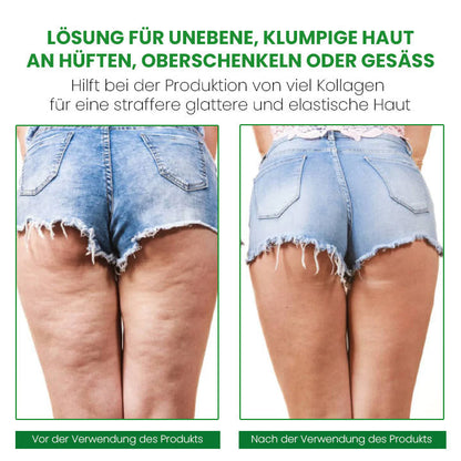SusoSkin Profi 2-in-1-Kräuterbalsam zur Beruhigung von Cellulite