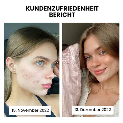 Thiccfitts™ Luxe Wunder Silk Anti-Acne Kopfkissenbezug