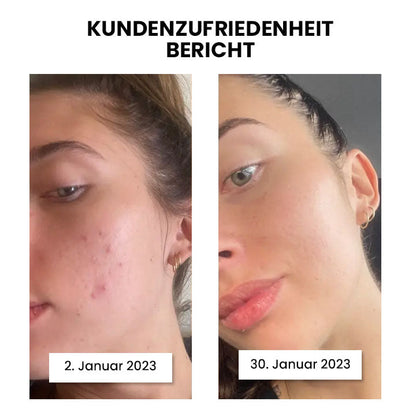 Thiccfitts™ Luxe Silk Anti-Acne Kopfkissenbezug